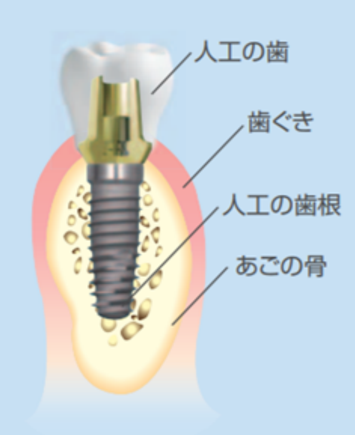 インプラント