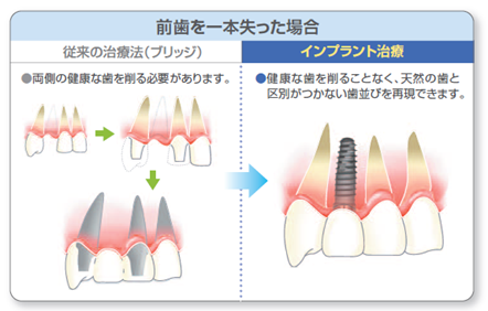 前歯を1本失った場合