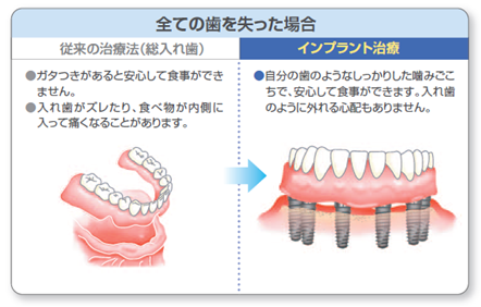 全ての歯を失った場合