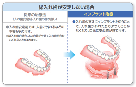 総入れ歯が安定しない場合